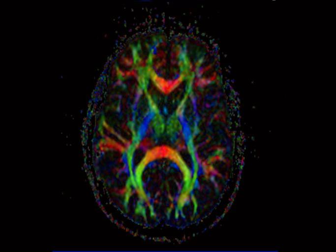 syngo&reg; DTI Evaluation