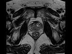 Siemens - MRI - MAGNETOM Sempra - Image - Prostate MRI