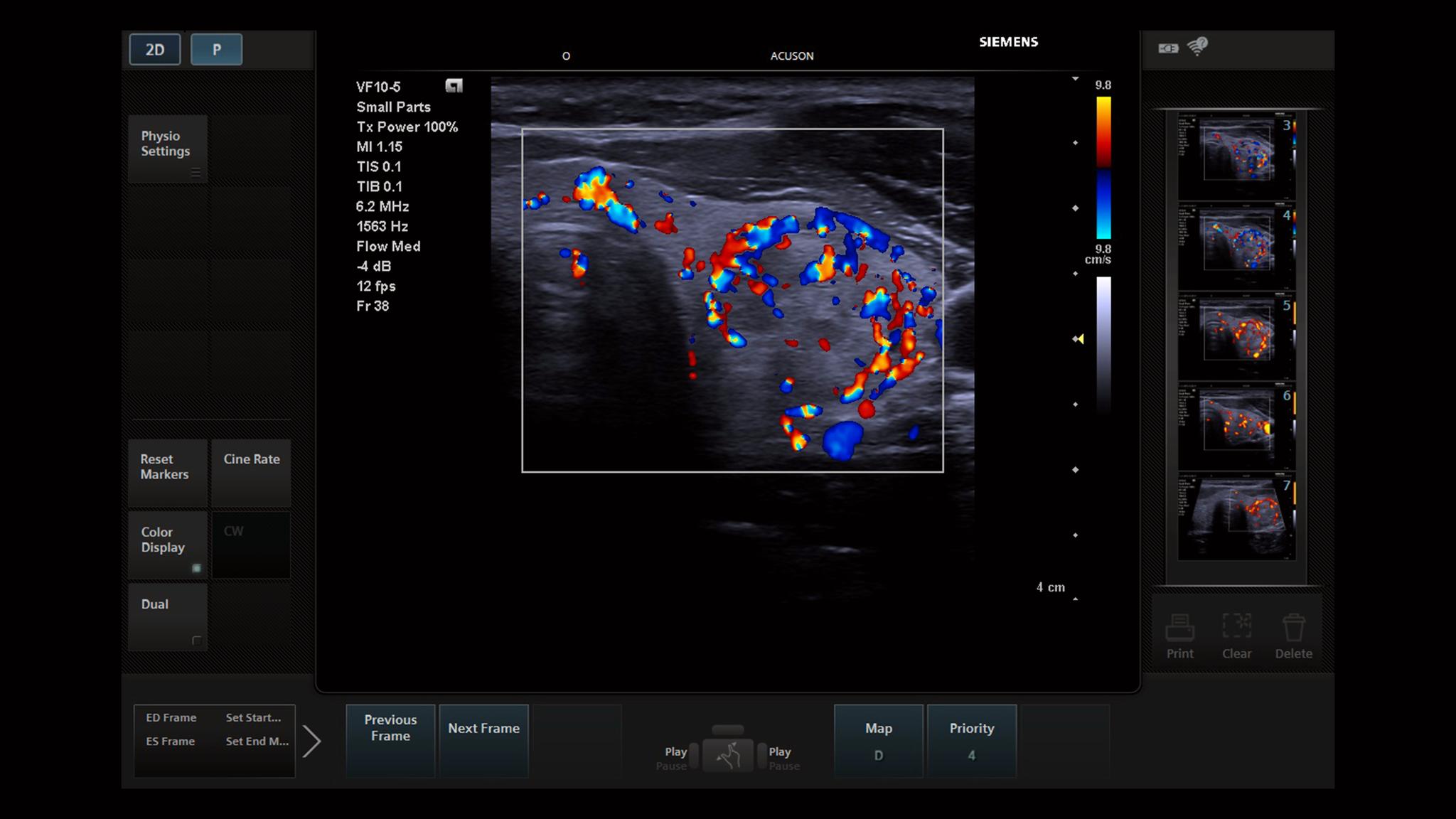 ACUSON P500 Ultrasound System - Siemens Healthineers
