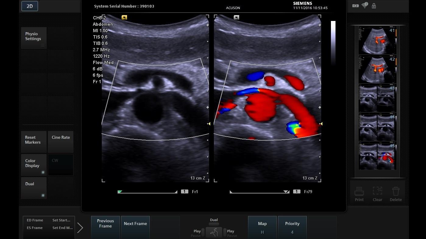 Clarify Vascular Enhancement (VE) Technology