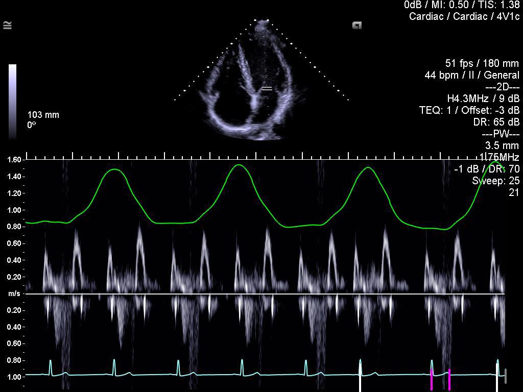 Apical 4-chamber view showing inflow with Transthoracic impedance respirometer (TIR) with 4V1c transducer. 