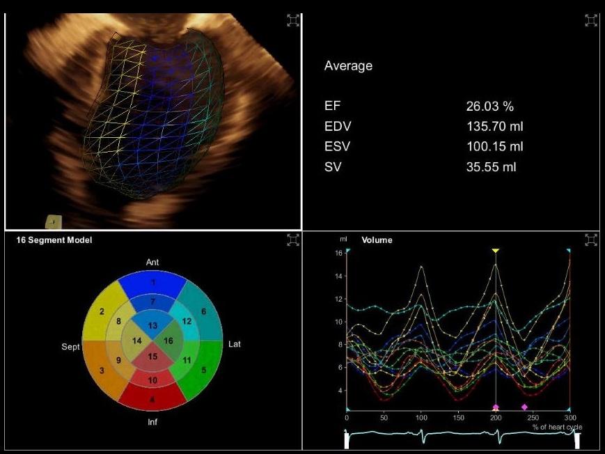 Left ventricular analysis (LVA) performed on a dilated heart imaged with the Z6Ms True Volume TEE transducer.