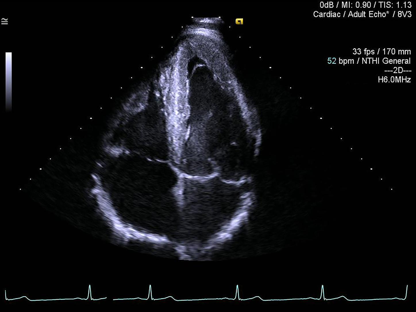 Apical 4-chamber view with  IN Focus on the 8V3 transducer. 