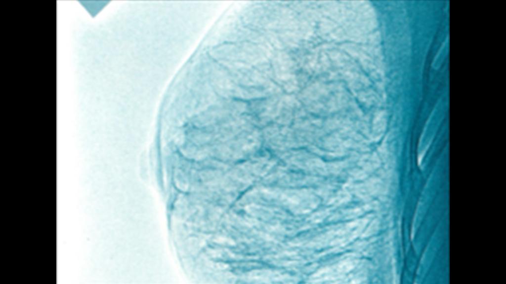 History of mammography Siemens Healthineers India