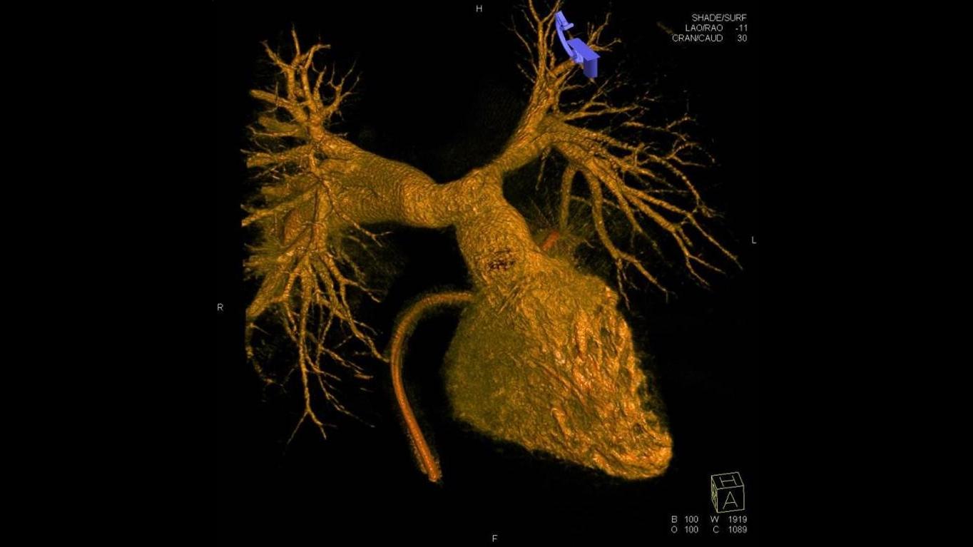 3DRA of the Right ventricle and Pulmonary arteries