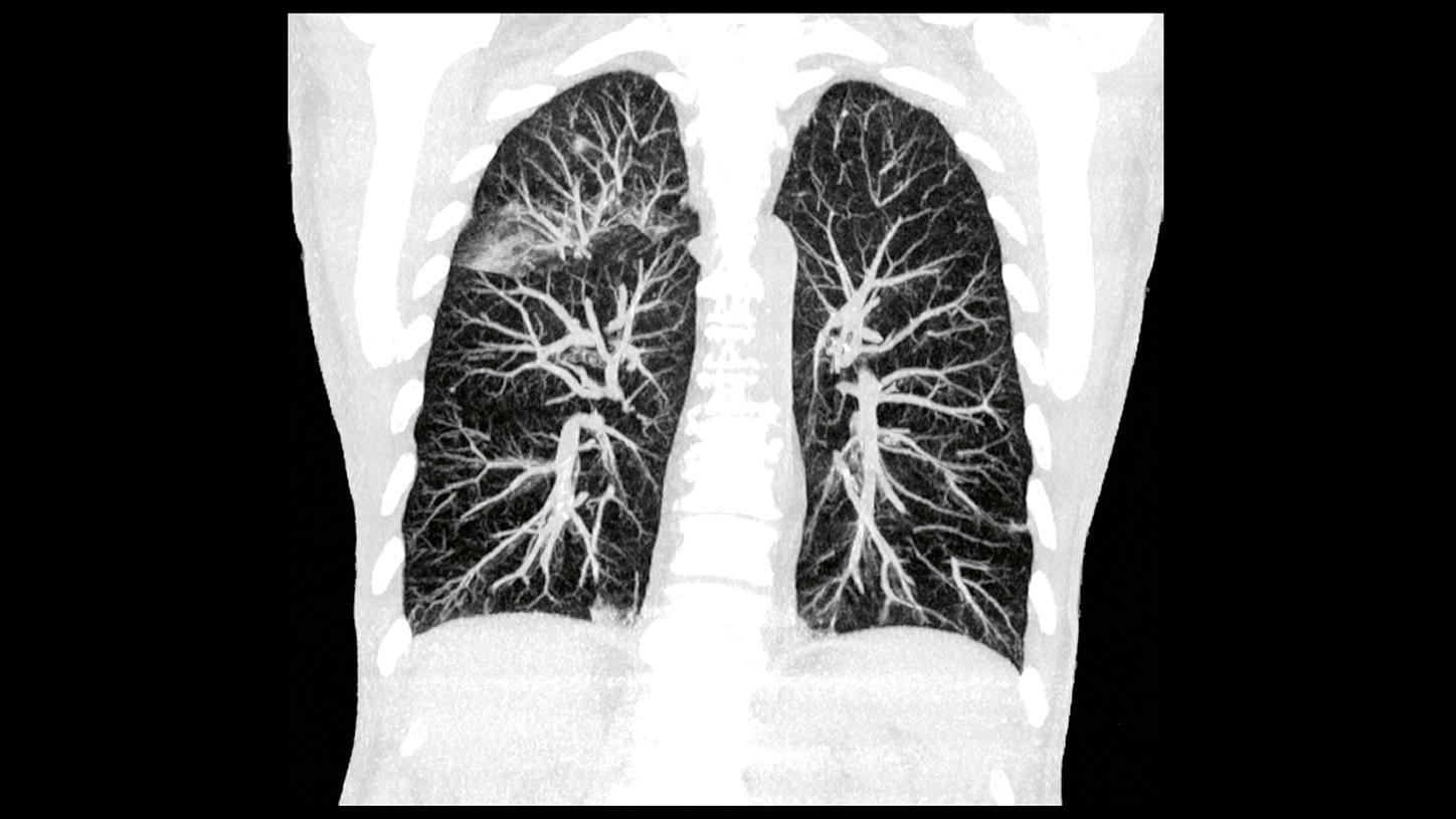 Lung imaging; Stretch the limits of low-dose scanning with Tin Filter technology;<br />Courtesy of Erlangen University Hospital, Erlangen, Germany