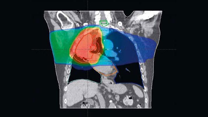 Planning particle therapy precisely improves radioation therapy treatment in oncology. 