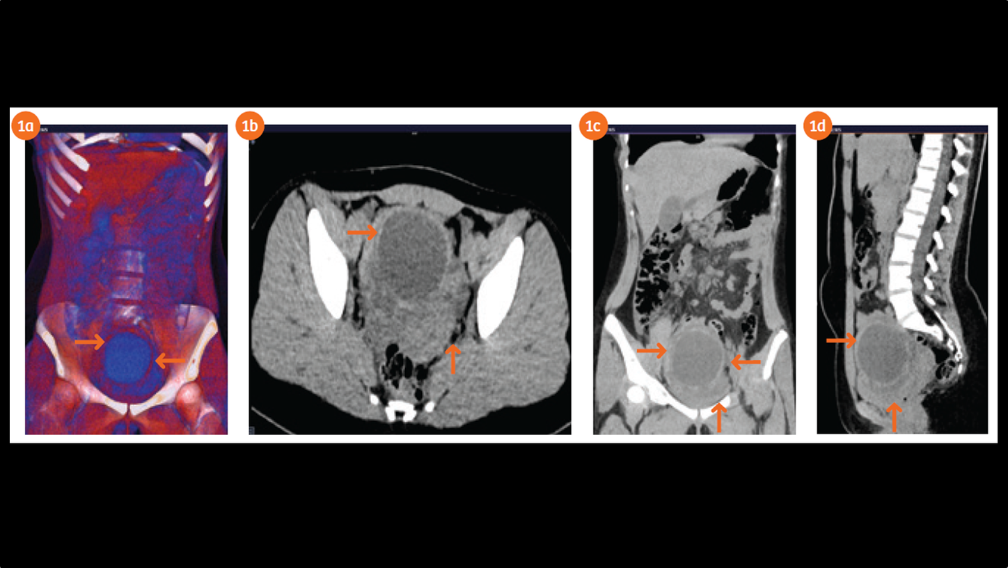 CT (Fig. 1a-1d). VRT (Fig. 1a), Axial (Fig. 1b), coronal MIP (Fig. 1c) and Sagi_al images (Fig. 1d).