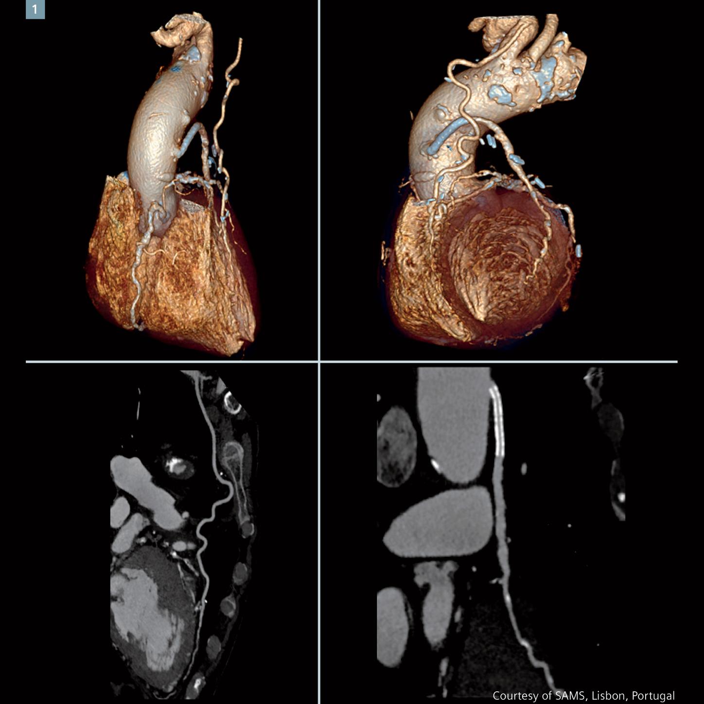 Reduced radiation dosage