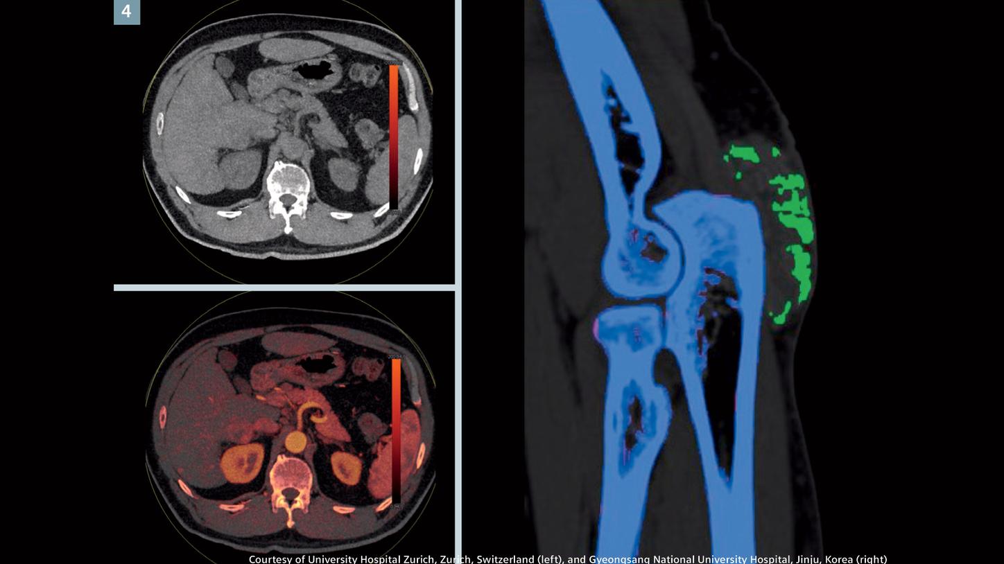 Fig. 4: Dual energy imaging &ndash; the Selective Photon Shield allows dedicated filtration and better separation of the low and high energy spectrum, which significantly improves material differentiation in dual energy imaging. A virtual non-contrast (VNC) and a fused VNC/iodine image (left) reveal an enhanced lesion in the right hepatic lobe, segment VI, indicating a metastasis. Gout crystals are demonstrated in the posterior elbow (right).