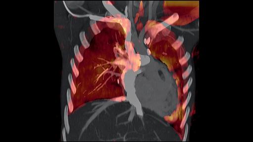 Dual Energy CT Lung Perfusion Imaging in Children - Siemens ...