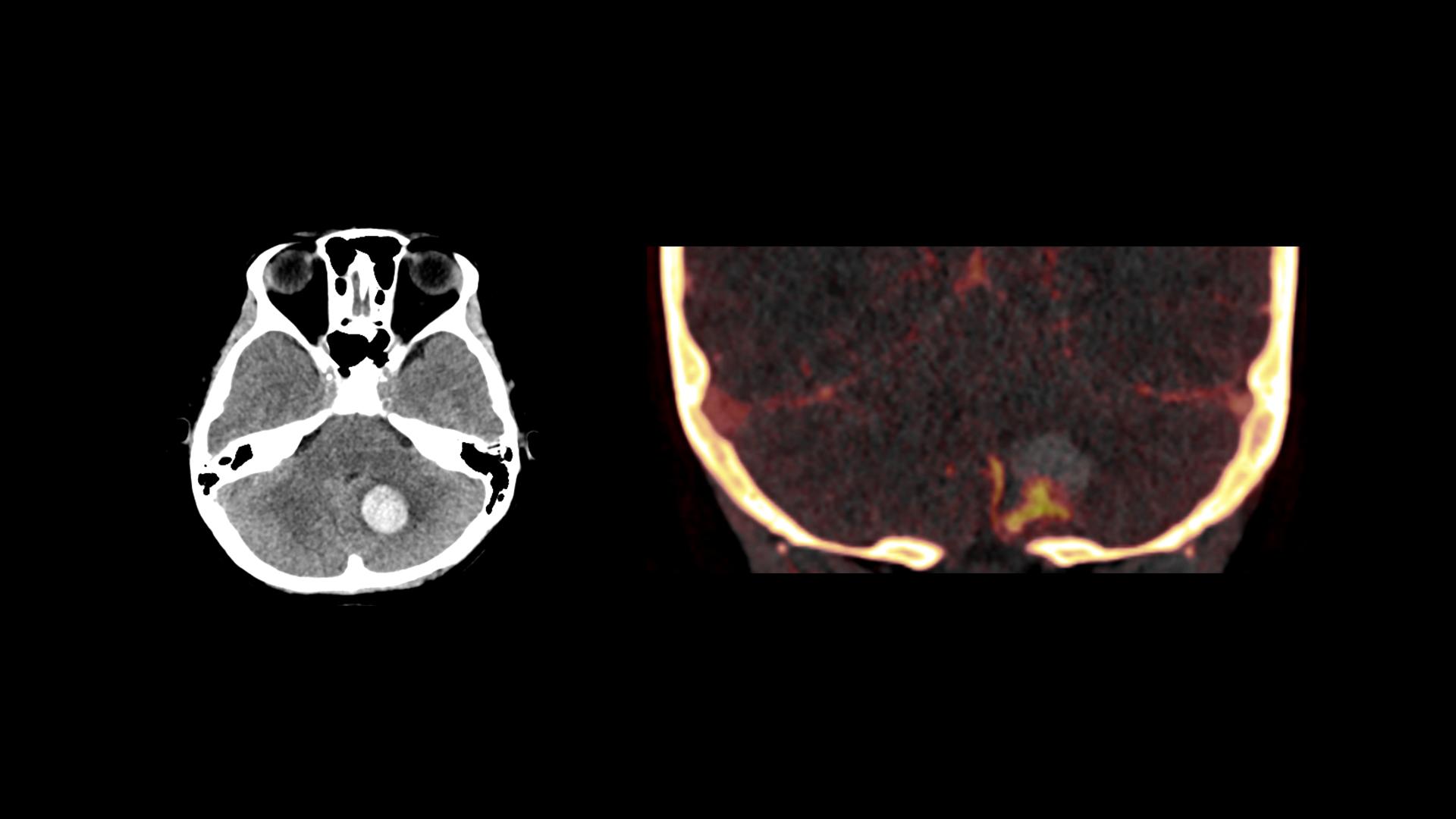 Cerebellar Arteriovenous Malformation – Complicated by Active Bleeding ...