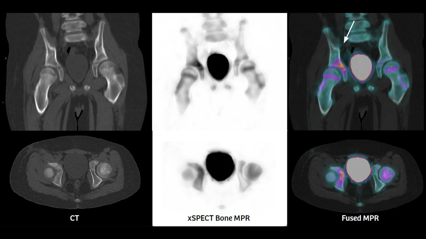 xSPECT Bone MPR, Fused MPR, and CT images aide in a diagnosis of acetabular osteomyelitis.