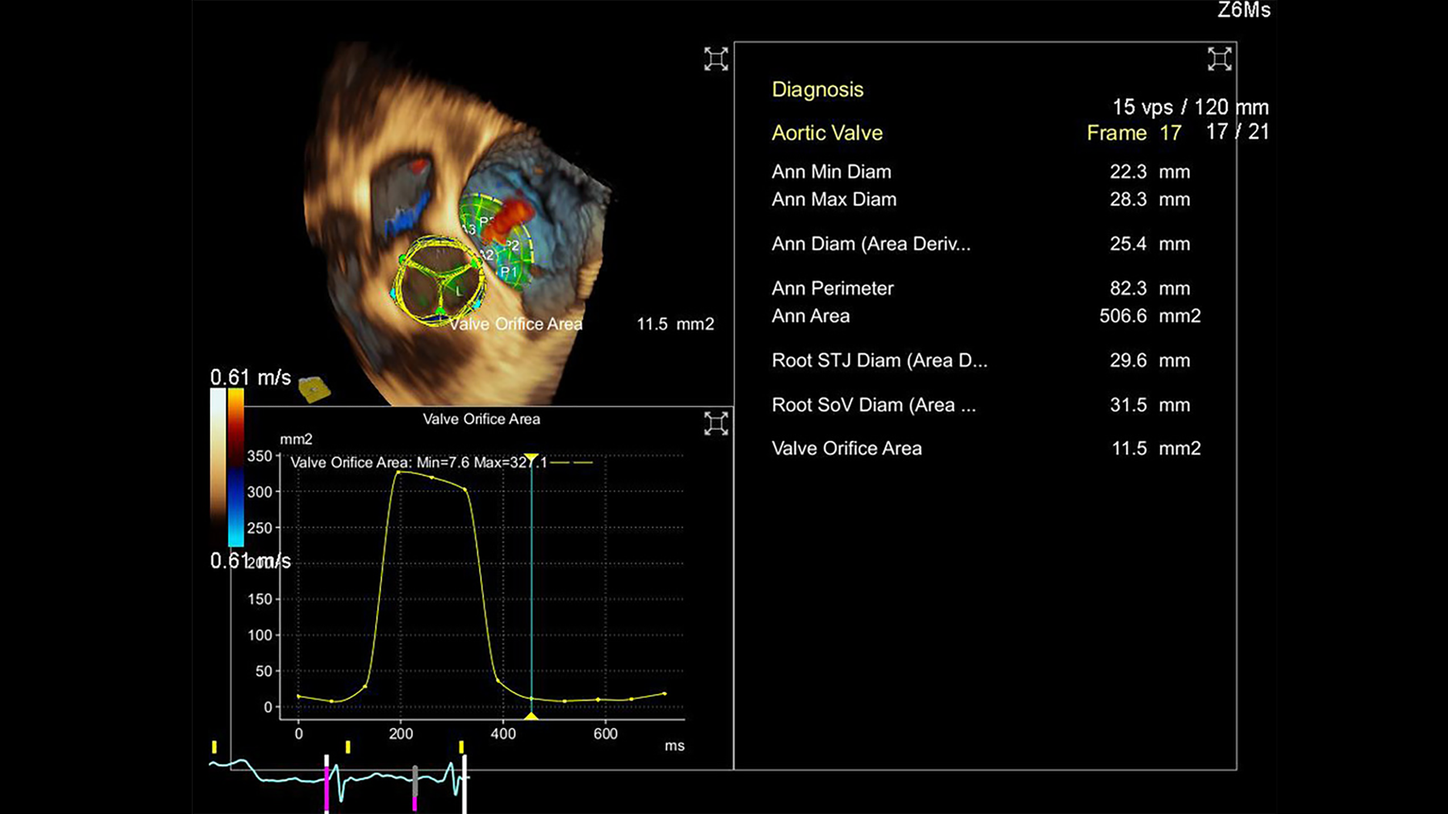 eSie Valves&trade; Advanced Analysis Package