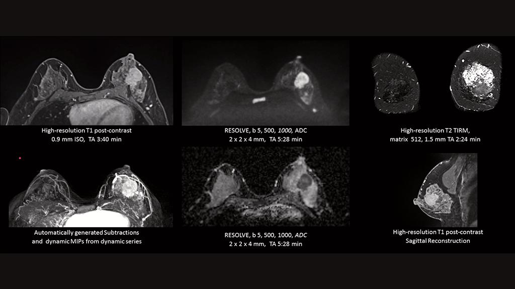 Diffusion-weighted imaging of breast begins to come of age