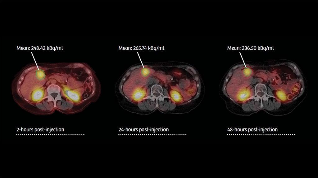 xSPECT Quant enables the quantification of SPECT/CT images.