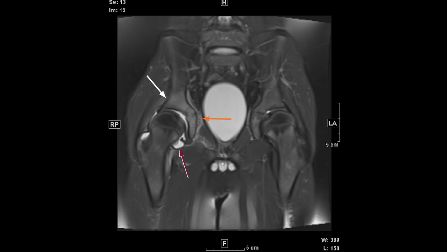 MRI image shows early marrow changes indicative of acetabular osteomyelitis.