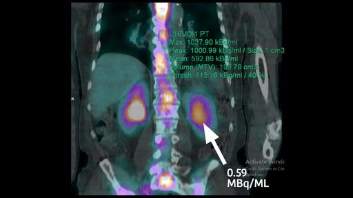 Reliable quantitative SPECT/CT with xSPECT Quant - Siemens Healthineers USA
