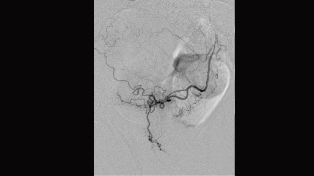 Minimally invasive treatment is given to patients with benign prostatic hyperplasia.