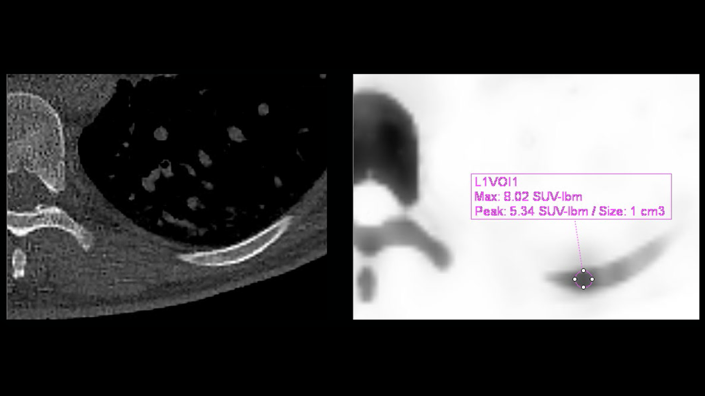 A xSPECT Quant image quantifies a rib lesion on a SPECT/CT scan.