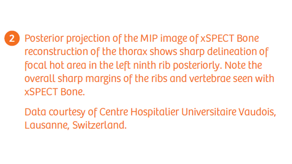 Specttcular Rib Differentiation of a rib benign lesion from a metastasis using xSPECT ...