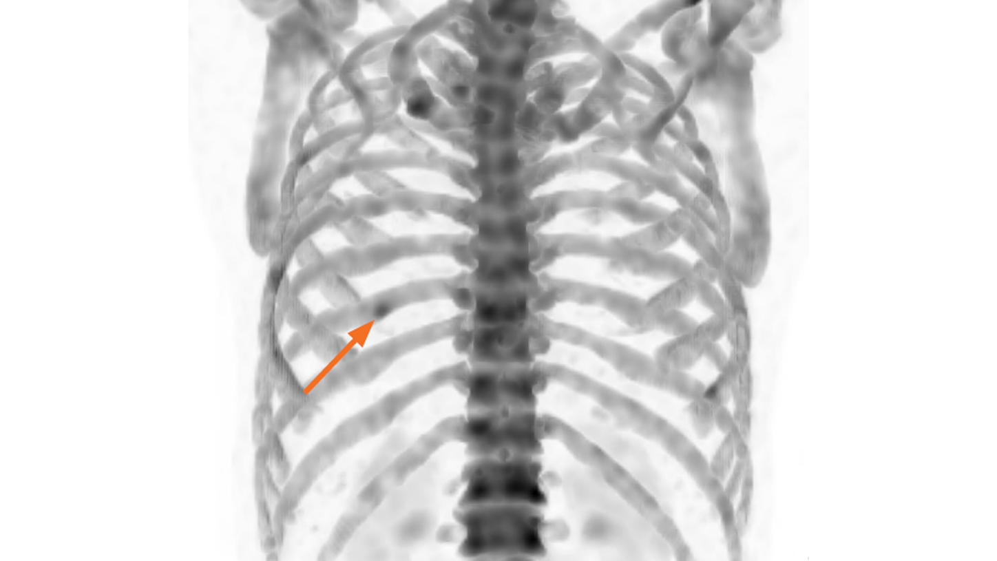 A MIP xSPECT Bone image further delineates a lesion in the left ninth rib of a patient with a history of prostate cancer.