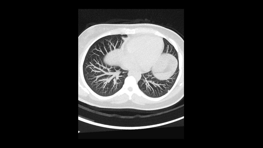 Lung cancer detection with computed tomography (CT scan)