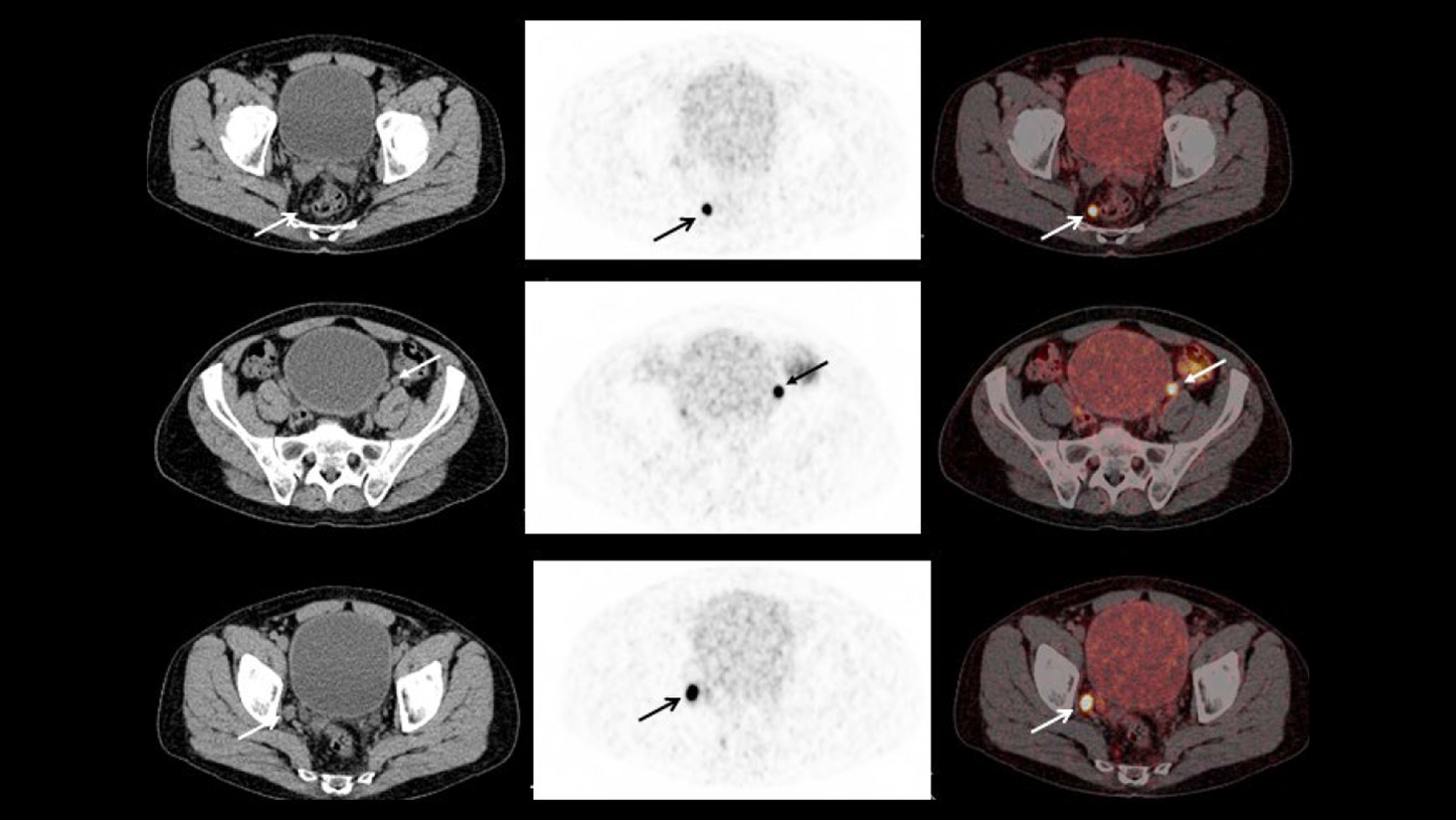 CT, PET, and fused PET/CT images show 68Ga PSMA-avid lymph node metastases.