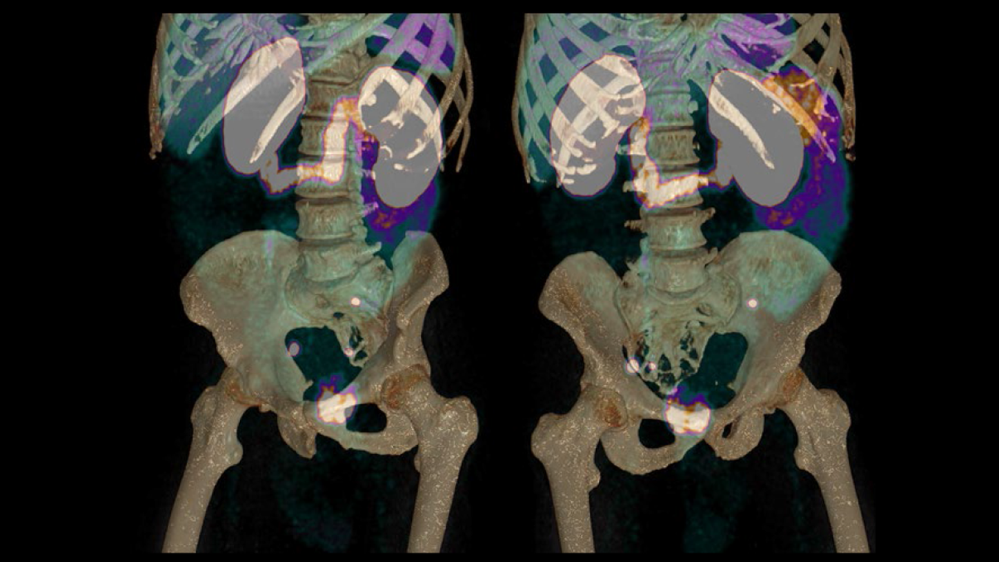 The relationship between lymph node metastases and the pelvis is shown by volume rendering of fused PET/CT images.