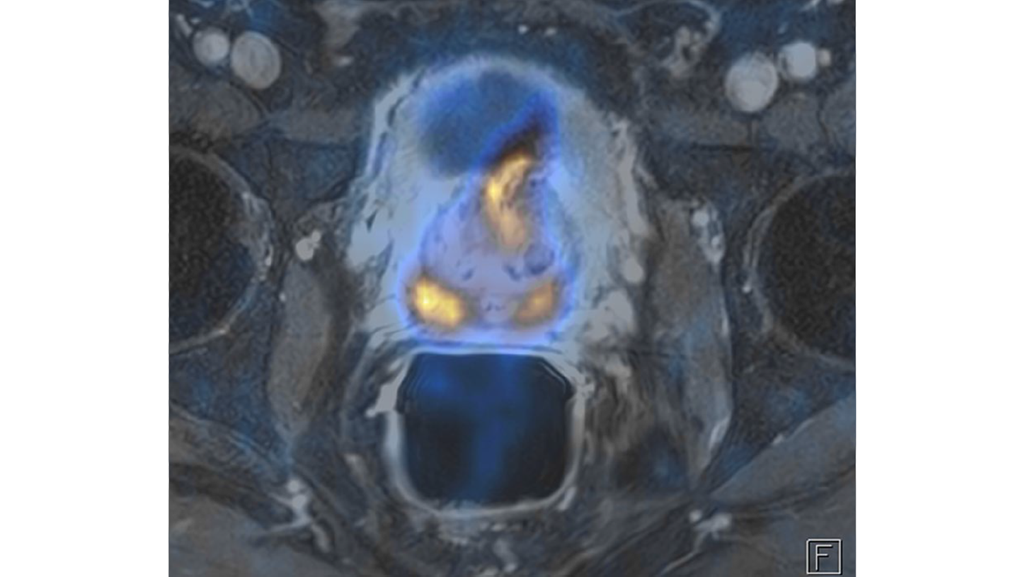 A fused 68Ga PSMA PET and pelvic MRI data shows a tracer-avid primary tumor with extension into the adjacent bladder wall.