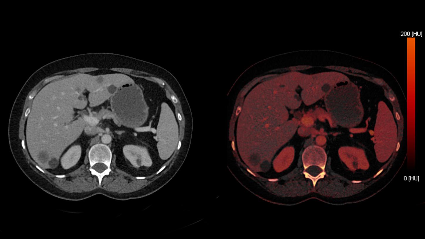 To assess metastatic disease, a contrast-enhanced TwinBeam Dual Energy (TBDE) CT was performed.