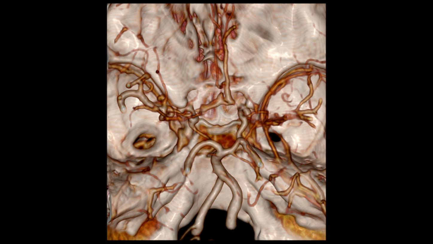 CT angiography and volume perfusion CT scans were requested for preoperative planning of moyamoya disease.