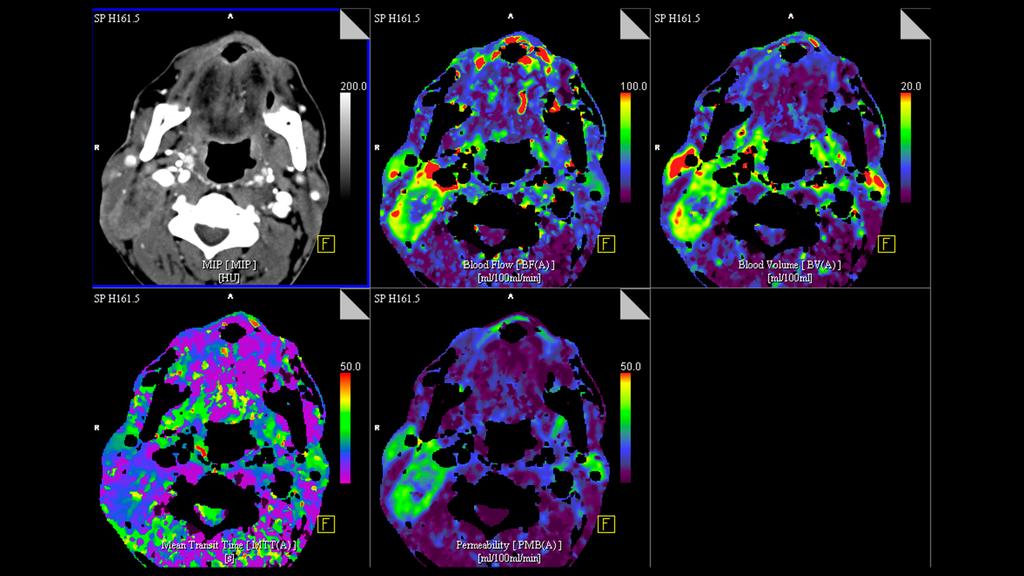 Squamous Cell Carcinoma of the Head and Neck: Volume Perfusion CT