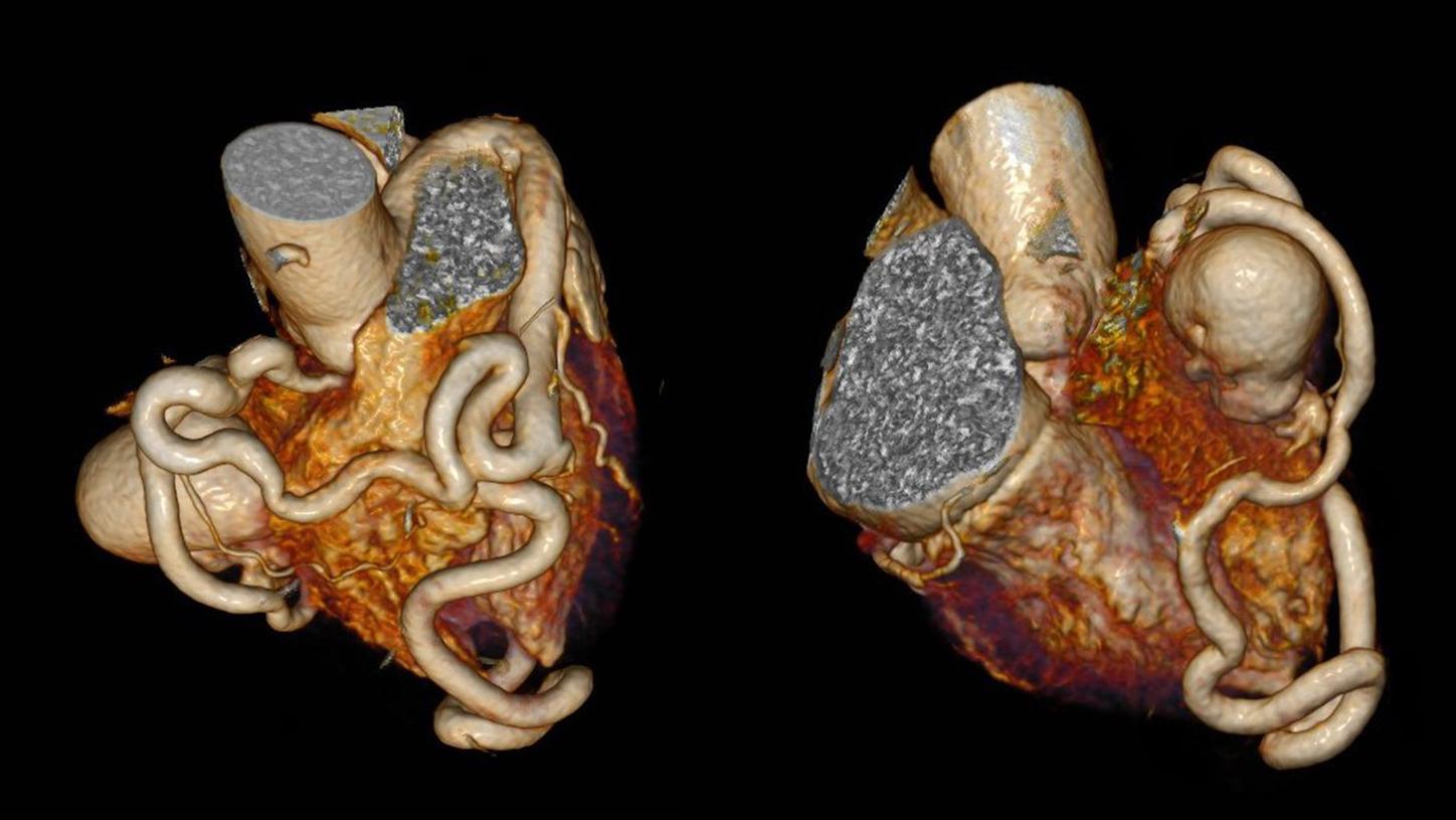 A coronary CT angiography was performed after an ECG to further evaluate chest distress in 44-year-old female patient.