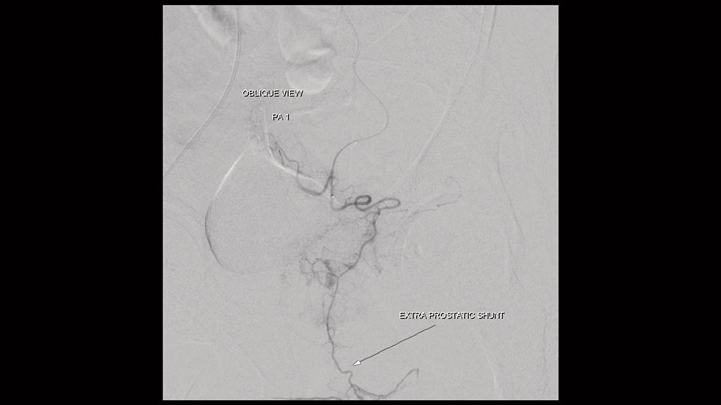 Embolization procedure is used for the treatment of prostatic hyperplasia.