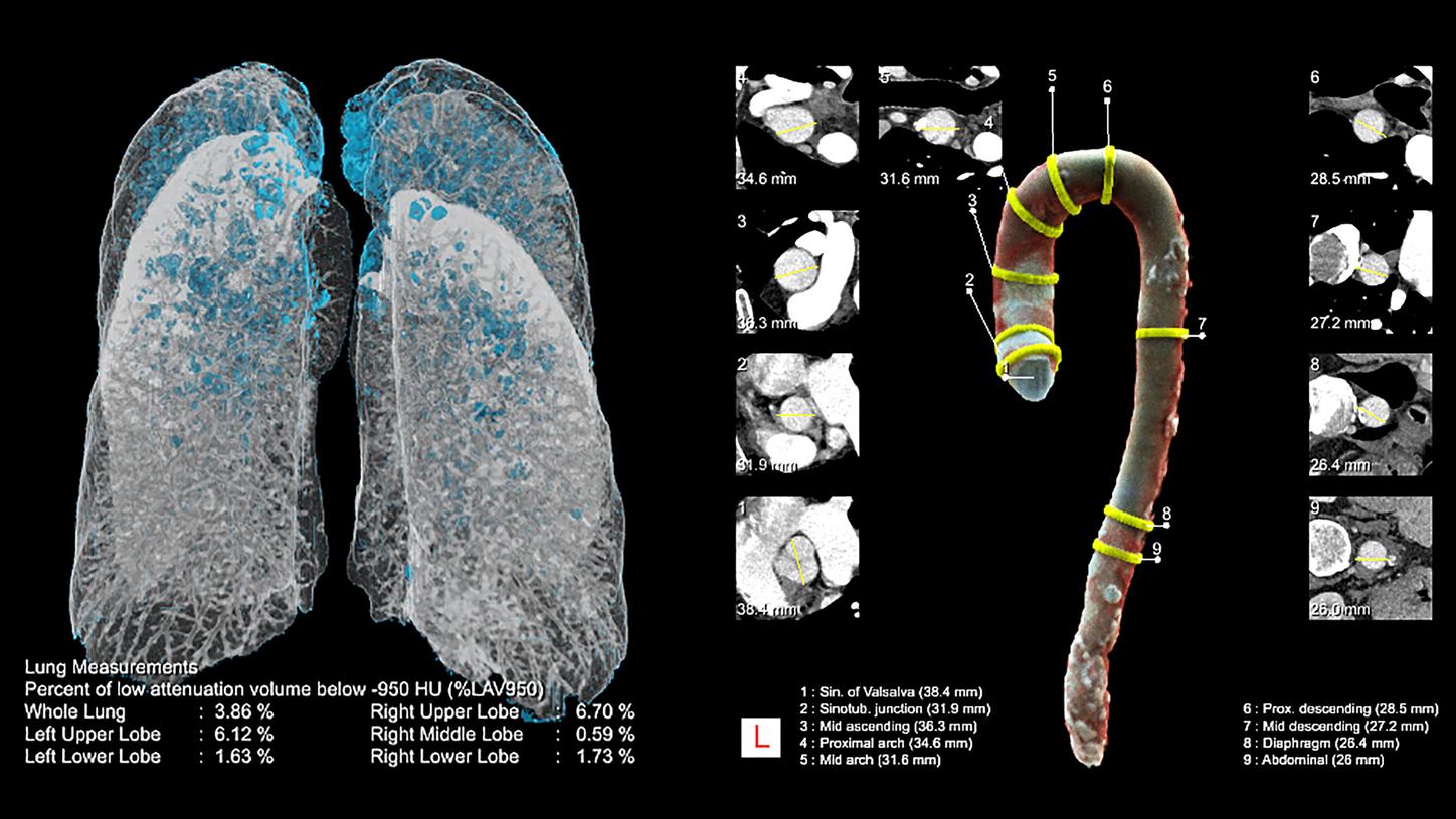 Thoracic imaging or chest CT examinations can be supported by artificial intelligence.