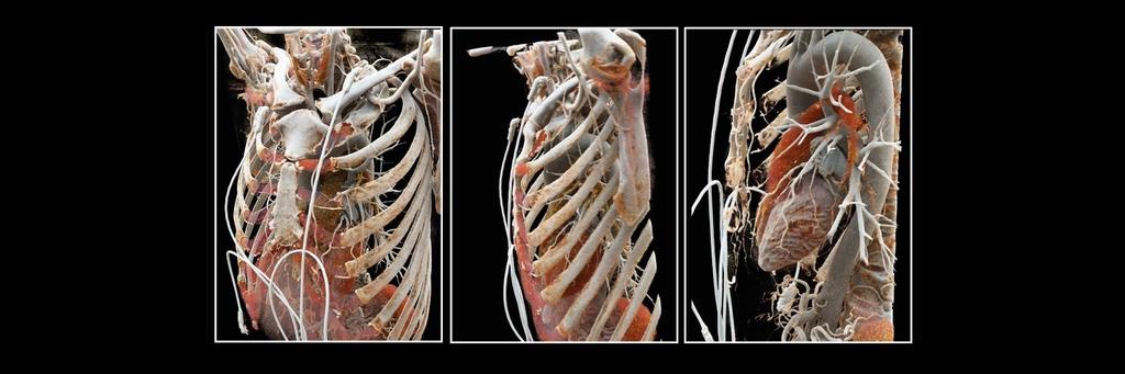 Cinematic Rendering in medical imaging - Siemens Healthineers