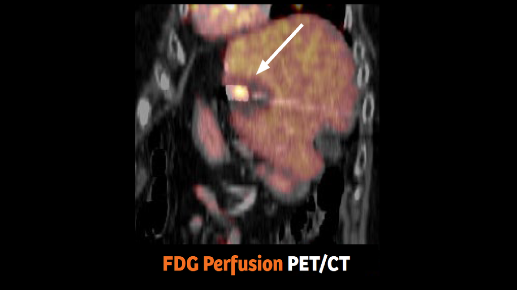 Dual injection PET/CT-guided intervention for ablation of liver ...