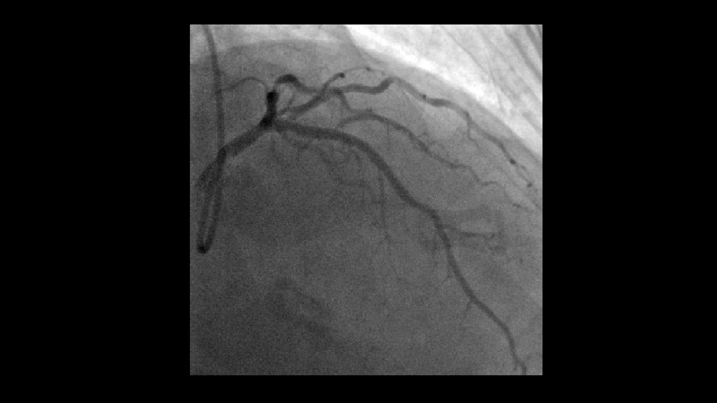 Following the percutaneous transluminal coronary angioplasty (PTCA) and stent placement, angiographic images show restoration of normal flow in the LAD and branche