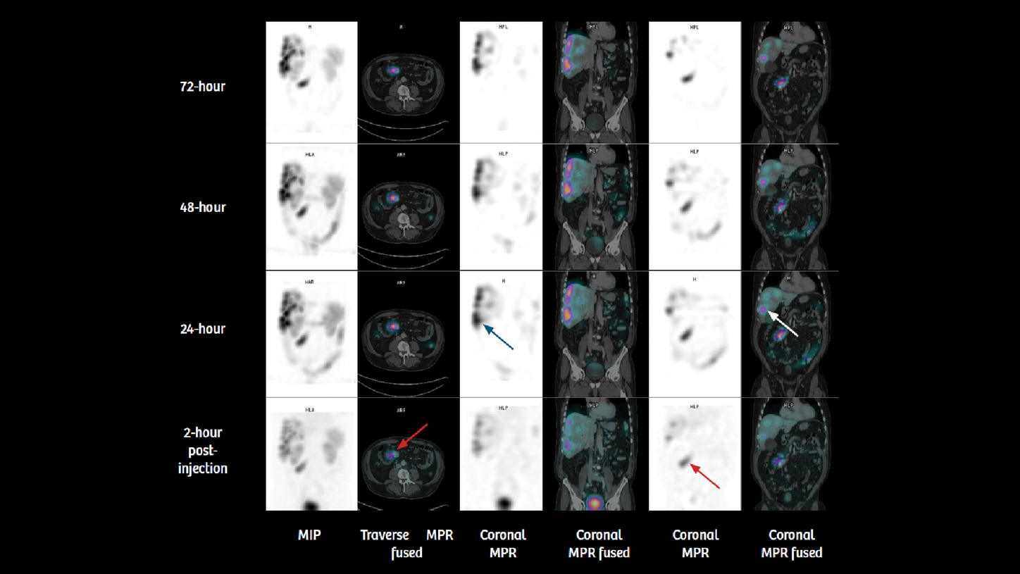 Four sequential time point SPECT/CT scans were performed following 7.4 GBq 177Lu DOTATATE administration in a patient with intestinal carcinoid tumor with multiple liver metastases. 