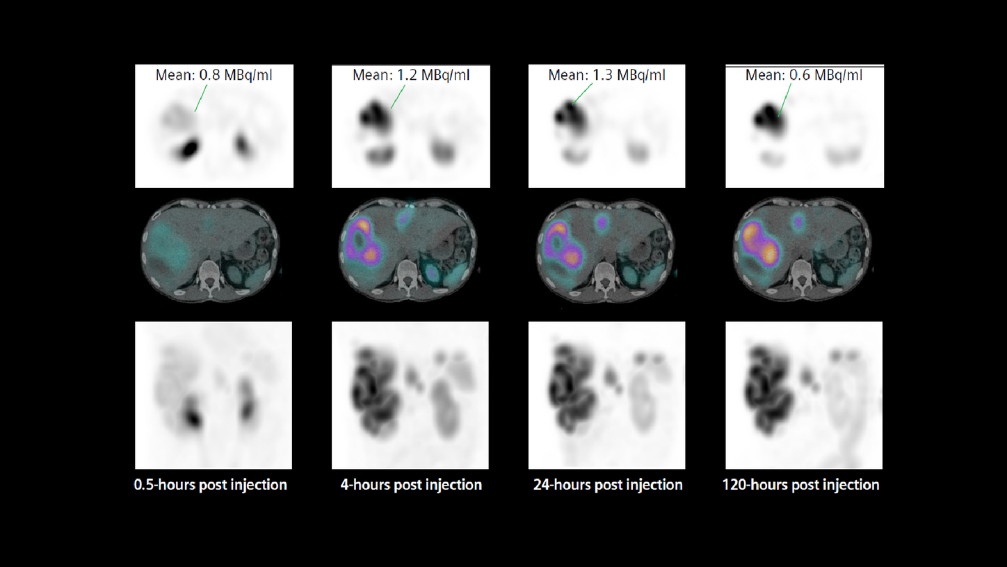 Evaluation of absorbed dose using sequential quantitative SPECT/CT following 177Lu DOTATATE metastatic neuroendocrine tumor therapy