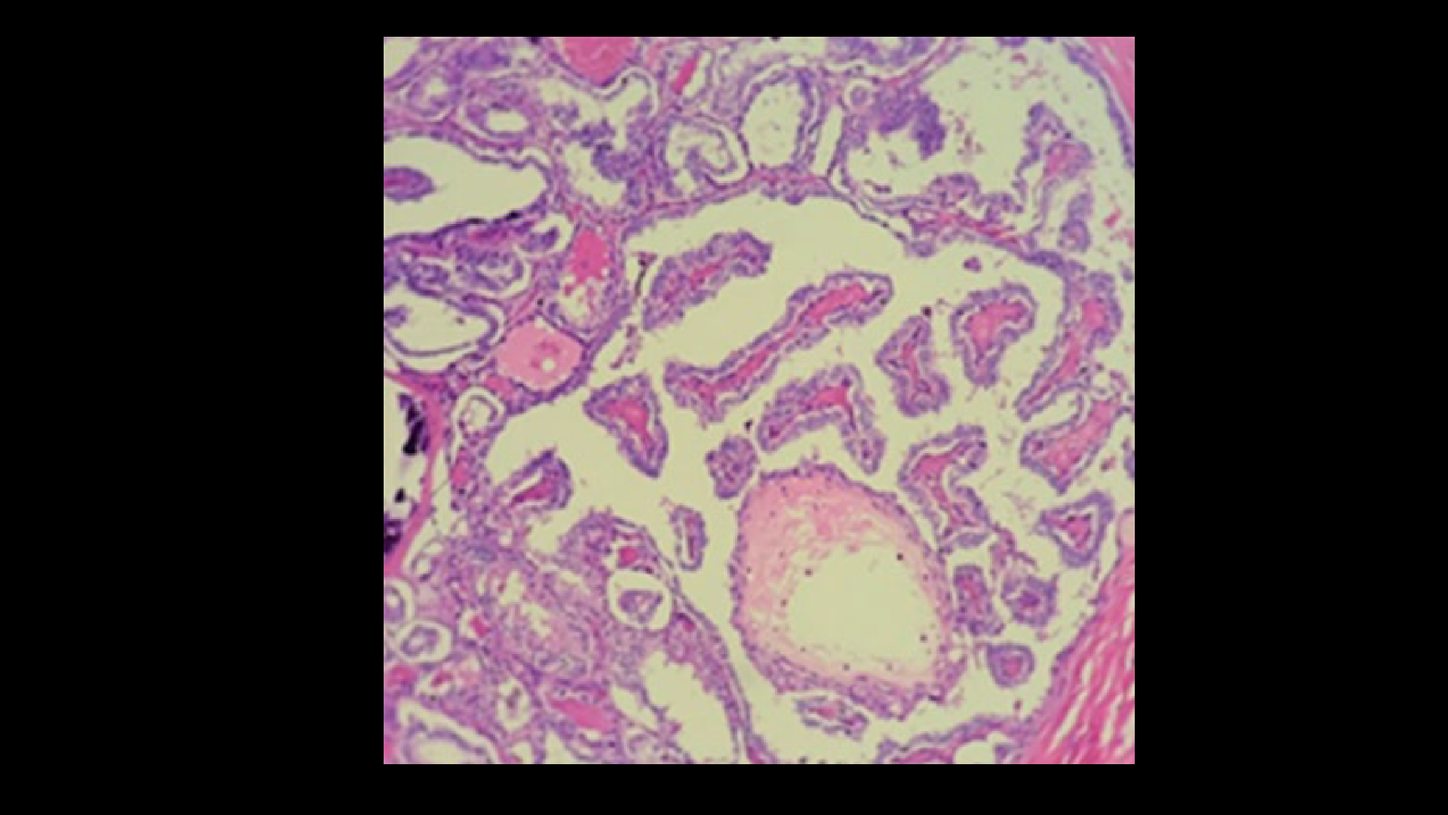 Histopathology from resected recurrent neck nodules demonstrated presence of papillary thyroid carcinoma.