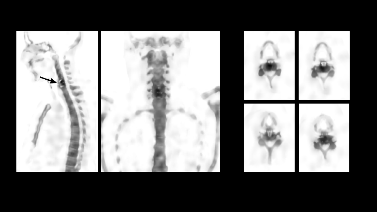 Sagittal, coronal, and transverse multiplanar reconstruction (MPR) views of xSPECT Bone reconstruction show significantly increased uptake within the C5-C6 disc space (SUVmax = 13.3)