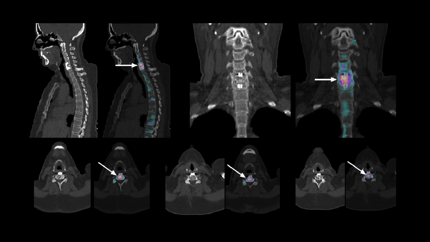 CT and fused xSPECT and CT image