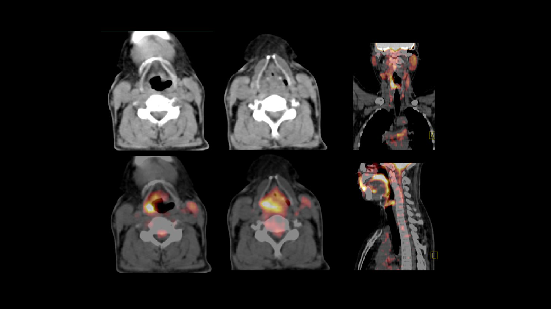 Coexisting laryngeal tumor in a patient with esophageal carcinoma ...
