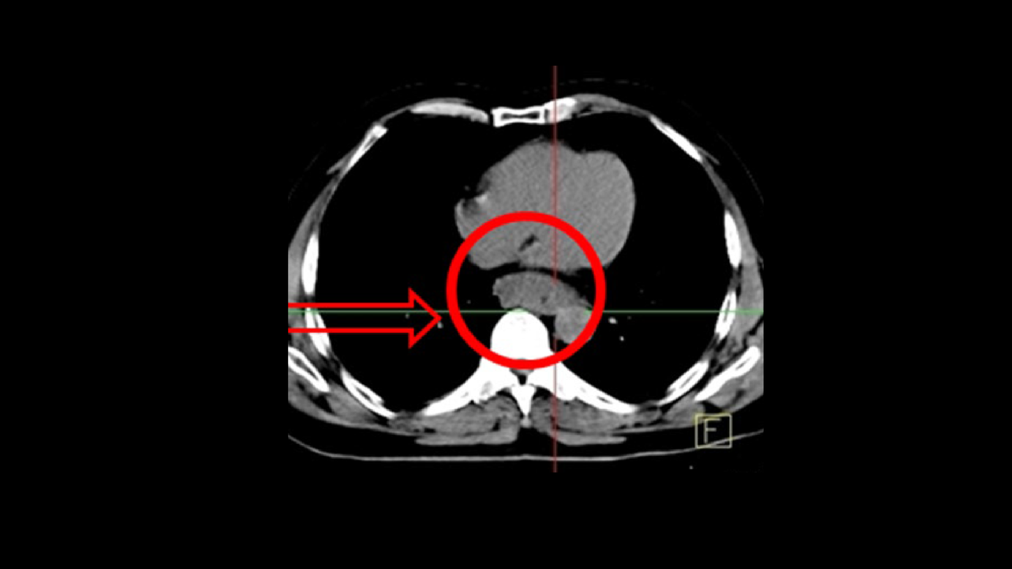 Esophageal mass in the lower third with a gross luminal narrowing seen on CT.