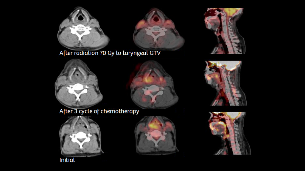 Coexisting laryngeal tumor in a patient with esophageal carcinoma ...