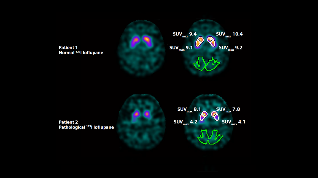 Datquant Spect xSPECT Quant - Siemens Healthineers