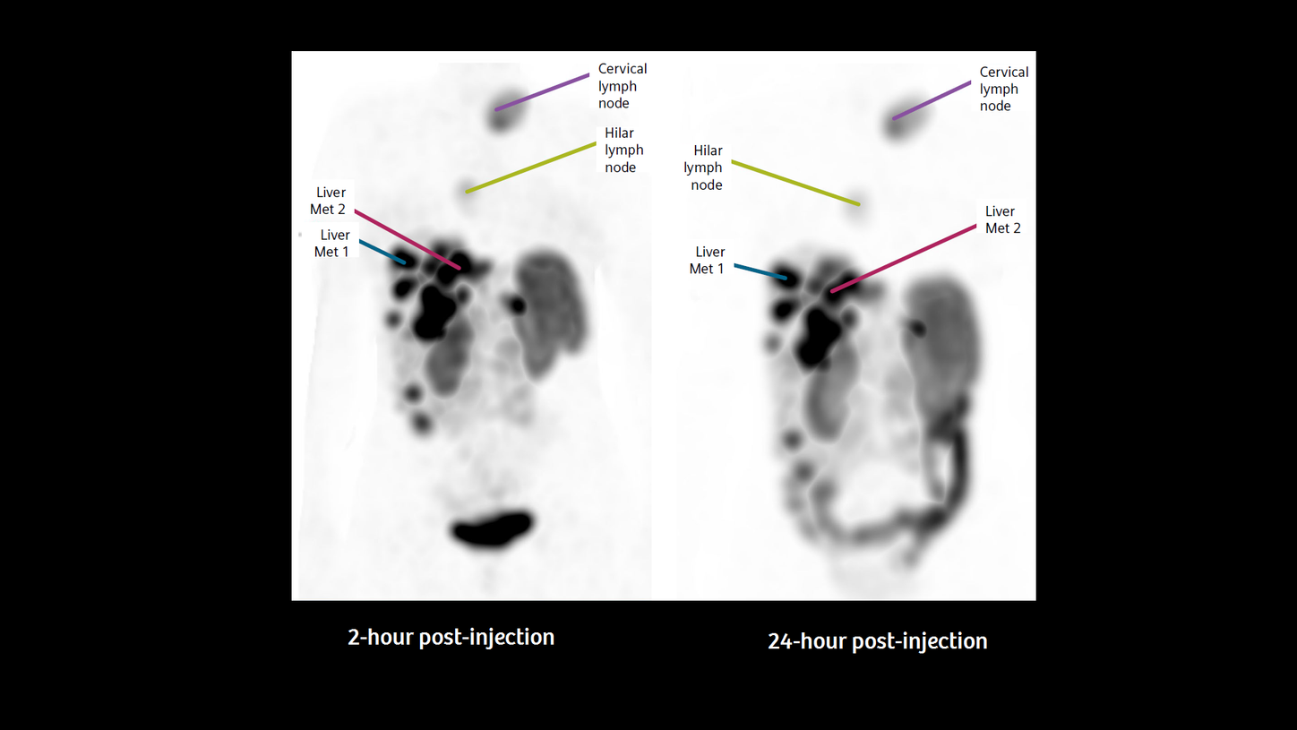 Coronal view of the maximum intensity projection (MIP) of the xSPECT data from both time points, showing four different lesions. Selection of the lesions is for demonstration purposes only.