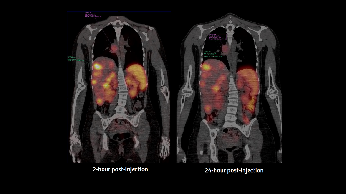 Coronal view of a fused xSPECT/CT image with measure-ments of one of the liver lesions as well as the hilar lymph node metastasis. Note the automated SUV mea-surements using syngo®.via. The tracer distribution, retention and elimination can be identified by comparing the two time points.